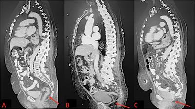 Case Report: Robotic Repair of a Perineal Hernia Following Abdominoperineal Resection